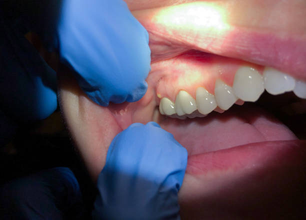 Best Cracked Tooth Emergency Dentist  in Mbrian Park, CA