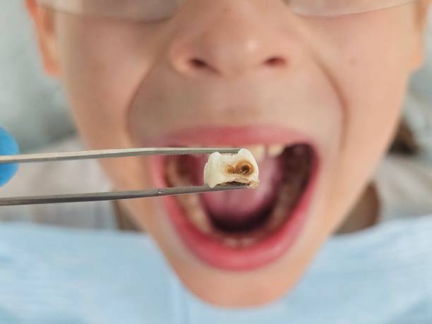 Best Chipped Tooth Repair Near Me  in Mbrian Park, CA